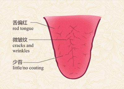 舌红少津是什么症状图片