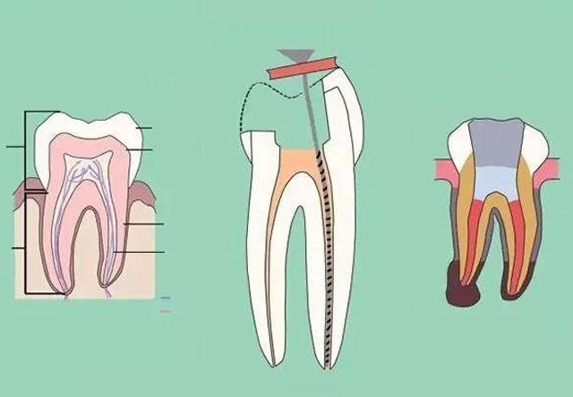 澳朗口腔根管治療