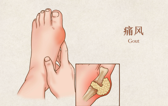 痛风急性发作秋水仙碱抗炎药糖皮质激素非布司他选谁最佳